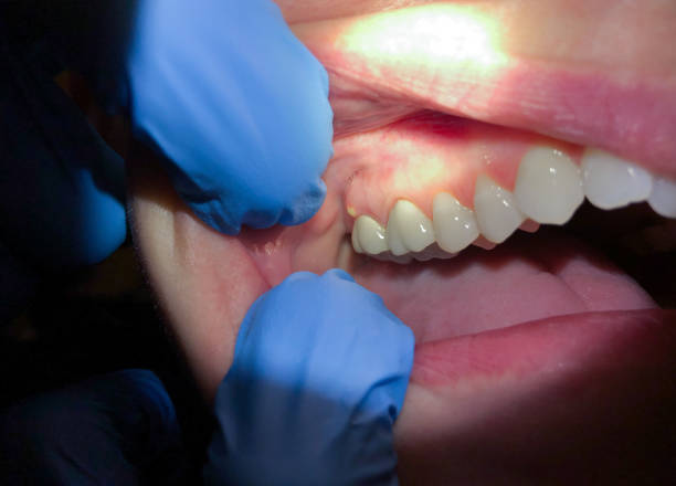 Best Emergency Cosmetic Dentistry (e.g., broken veneers) in Springdale, MD