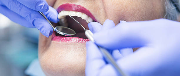 Best Knocked-Out Tooth (Avulsed Tooth) Treatment in Springdale, MD